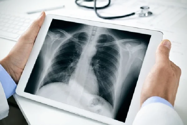 Interstitial Lung Disease