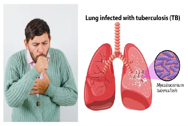 Tuberculosis