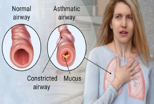 Allergy and Asthma