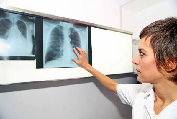 Pulmonary Vascular Disease