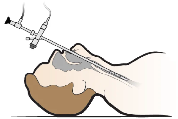 Rigid Bronchoscopy