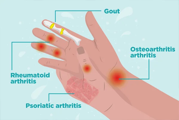 Arthritis Treatment